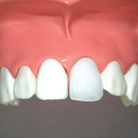 ジルコニアセラミック